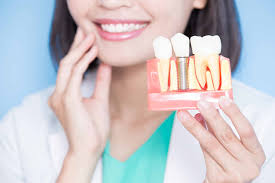 The Benefits of Dental Implants Beyond Aesthetics